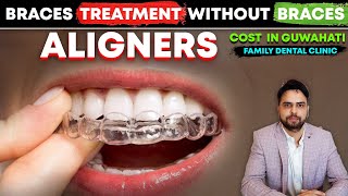 Cost of Aligners in Guwahati  Braces treatment without Braces  Invisible braces Clear Aligners [upl. by Ynaffyt]