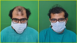 15 Months Hair Transplant Result amp 2nd Stage Marking amp Planning  FUE Result  Dr Jayanta Bain [upl. by Joyann319]