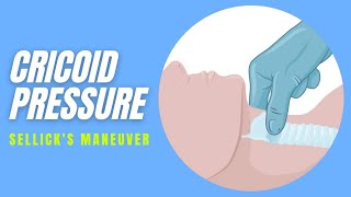 Cricoid pressure  Technique [upl. by Ttayw]