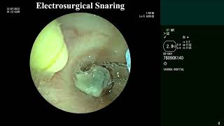 Rigid bronchoscopy  Tumor Debulking  Electrosurgical  Renal Cell Carcinoma airway metastasis [upl. by Picco]