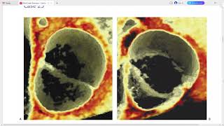 CARDIAC RAD CASE SERIES [upl. by Otsirc792]