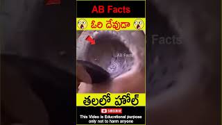 😲తలలో హోల్😲 hole in a mans head telugufacts facts factsintelugu shorts youtubeshorts abfacts [upl. by Steck]