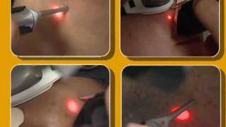 Laser Hair Removal video by Cynosure [upl. by Tiff263]