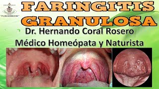 FARINGITIS GRANULOSA  INFLAMACIÓN DE LA FARINGE CON PERI ADENITIS COLORACIÓN ROJIZA [upl. by Esinert]