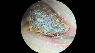 采耳哥Abnormal shaped earwax embolism and cleaning of large fungal dry patches in the ear canal [upl. by Benis657]