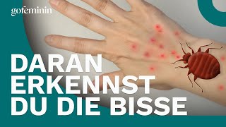 Bettwanzen Daran erkennst du die Bisse [upl. by Atileda]