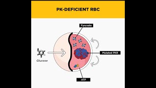 Phosphoglycerate Kinase Deficiency as a Disorder related to Glycolysis Pathway [upl. by Shurlock667]