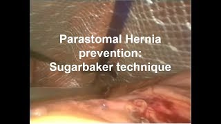 Parastomal Hernia Prevention Sugarbaker technique [upl. by Ofori]