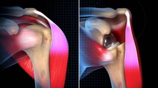 Biomechanical Summary of Reverse Shoulder Arthroplasty [upl. by Erika]