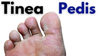 Tinea pedis symptoms and treatment  Toe fungus infection  athletes foot [upl. by Eitsyrc102]