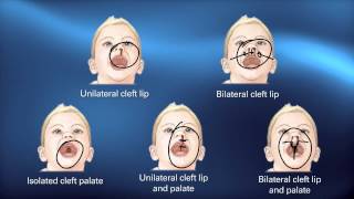 Cleft Diagnosis  Pediatric Playbook  Boston Childrens Hospital [upl. by Abrams]