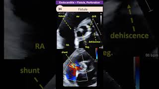 Endocarditis  Perforation  Fistula [upl. by Akela]