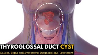 Thyroglossal Duct Cyst Causes Signs and Symptoms Diagnosis and Treatment [upl. by Orit]