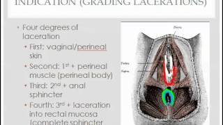 The ECG Course  AV Blocks [upl. by Towroy69]