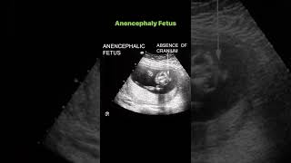 Anencephaly Fetus [upl. by Yaya609]