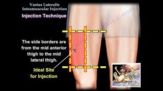 Vastus Lateralis Intramuscular Injection  Everything You Need To Know  Dr Nabil Ebraheim [upl. by Kaazi600]