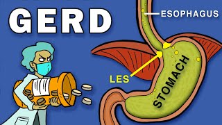 Gastroesophageal Reflux Disease GERD [upl. by Heger]