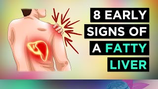 Fatty Liver The Silent Epidemic [upl. by Aineg]