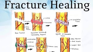 Fracture Healing Pathology [upl. by Norry]