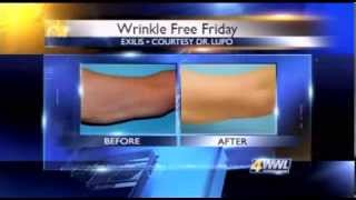 How to Tighten Skin on Sagging Arms with Exilis  Dr Mary Lupo [upl. by Malas612]