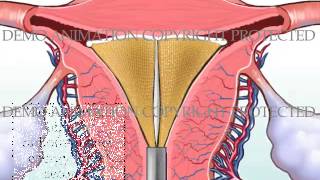 NovaSure Endometrial Ablation with PostOp Bleeding [upl. by Faletti829]