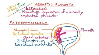 Abruptio placenta [upl. by Lunna819]