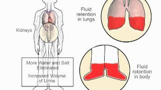 How diuretics work in heart failure  wwwheartfailuremattersorg [upl. by Eremahs]