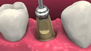 Restoring dental implants video BioHorizons [upl. by Animor500]