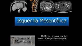 Isquemia Mesentérica parte 1 [upl. by Nnahgem959]