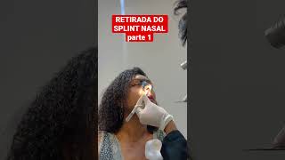 RETIRADA DO SPLINT NASAL parte 1  RINOPLASTIA cirurgia nariz rinoplastiasecundaria rinoplastia [upl. by Ennaimaj]