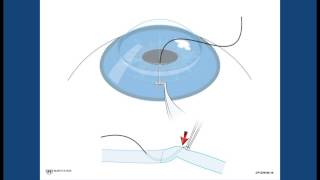 Corneal Suturing Part 4  Bringing the Needle to the Host Surface [upl. by Teillo226]