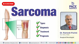 Sarcoma Cancer  Types Diagnosis Treatment amp Prognosis  sarcomatreatment [upl. by Brenn263]