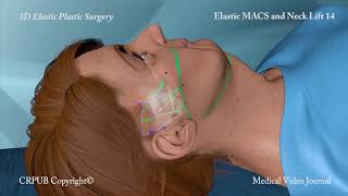 3D MACS and Neck Lift [upl. by Elman]