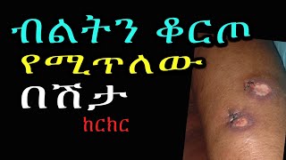 የወንድ ብልትን ቆርጦ የሚጥለው በሽታ ከርክር chancroid STI [upl. by Brannon601]