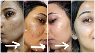 My Honest Morning Skincare Routine to remove Pimples amp Pimple Marks amp Get Glowing  Smooth Skin [upl. by Aluap]