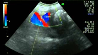 uterine artery doppler [upl. by Ahtera671]