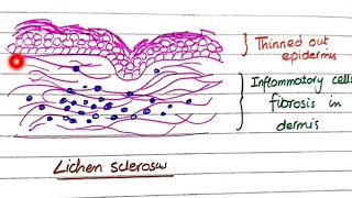 Lichen Sclerosus And Lichen Simplex Chronicus  Pathology [upl. by Quintie892]