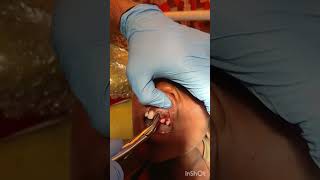 periapical abscess tooth extraction [upl. by David680]