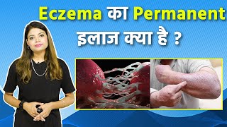 एक्जिमा का घरेलु इलाज क्या है  Eczema Ka Permanent Treatment Kya Hai  Boldsky [upl. by Ralston888]