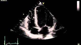 HYPERTENSIVE CARDIOMYOPATHY [upl. by Grados]