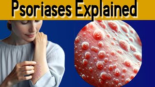 Psoriasis 101 explained under 3 minutes [upl. by Hadsall]