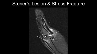 Steners Lesion amp Stress Fracture [upl. by Rozele]