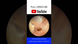 Chronic Suppurative Otitis Media Otoscopy [upl. by Yklam987]