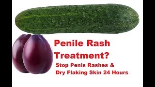 Penile Rash Treatment Stop Penis Rashes Dry Flaking Skin 24 Hours [upl. by Oos]