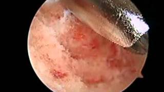 Posterior Arthroscopy with Haglunds Deformity Debridement SFISM [upl. by Halyak625]