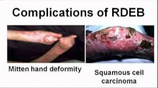 iPS Stem CellBased Treatment of Epidermolysis Bullosa [upl. by Eked]