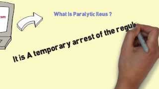 What Is Paralytic Ileus and Ways Of Ileus Treatment [upl. by Elianora106]