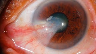 Pterygium Uncovering Causes and Symptomseyedoctor [upl. by Punak591]