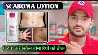 Scaboma lotion uses dose benefits and Side effects full review in hindi [upl. by Llarret]