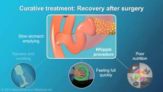 Pancreatic Cancer Treatment and Outcomes [upl. by Wilkins]